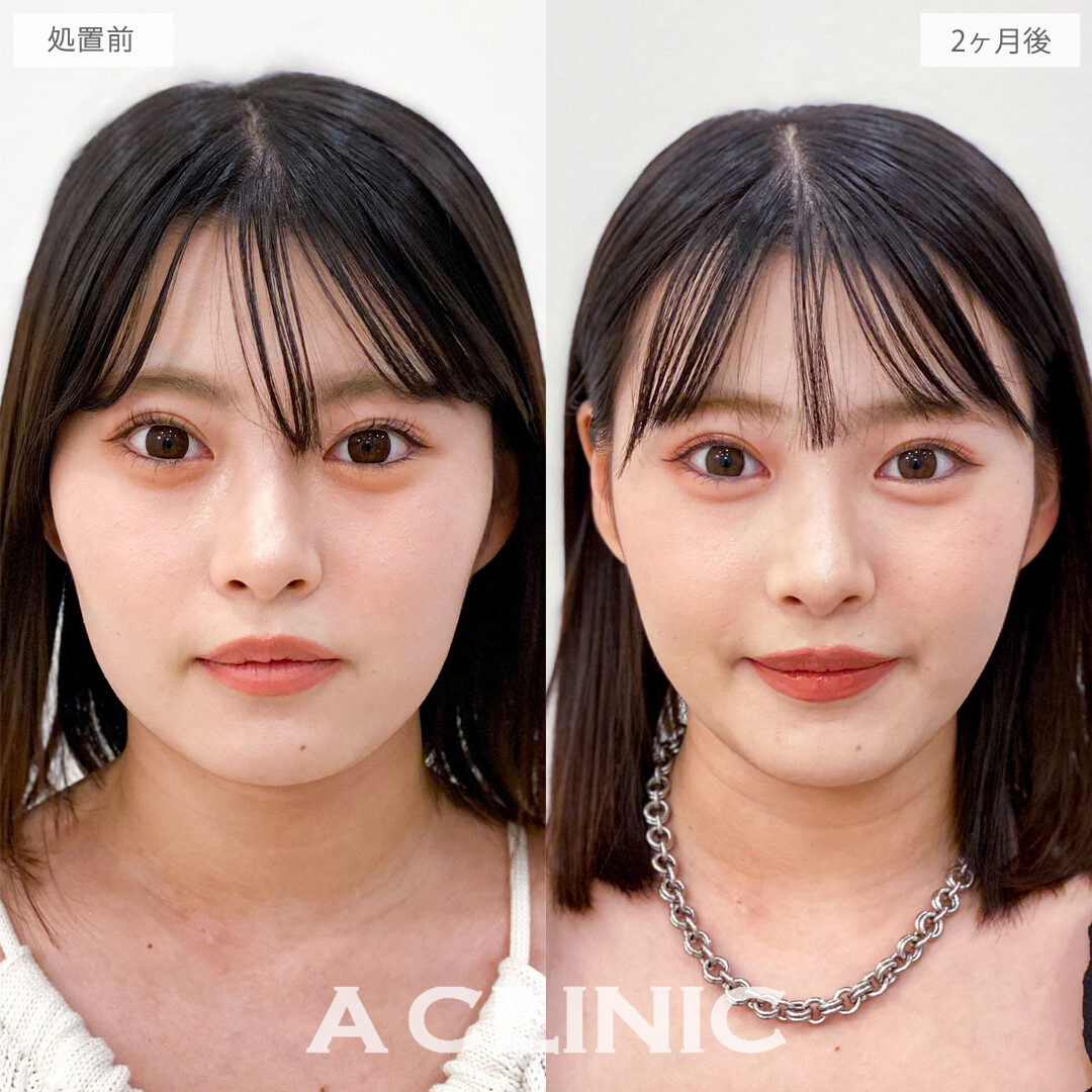 1day小顔脂肪吸引で品格あふれる洗練小顔をデザイン！こちら処置前と2か月後の症例です(20代女性)