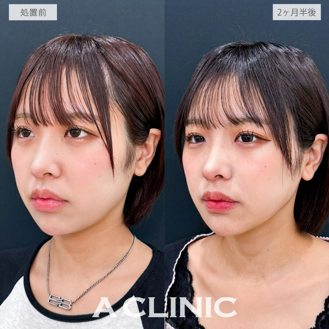 1day小顔脂肪吸引で余分な脂肪をなくして一気に垢抜けました！こちら処置前と2か月半後の症例です(20代女性)