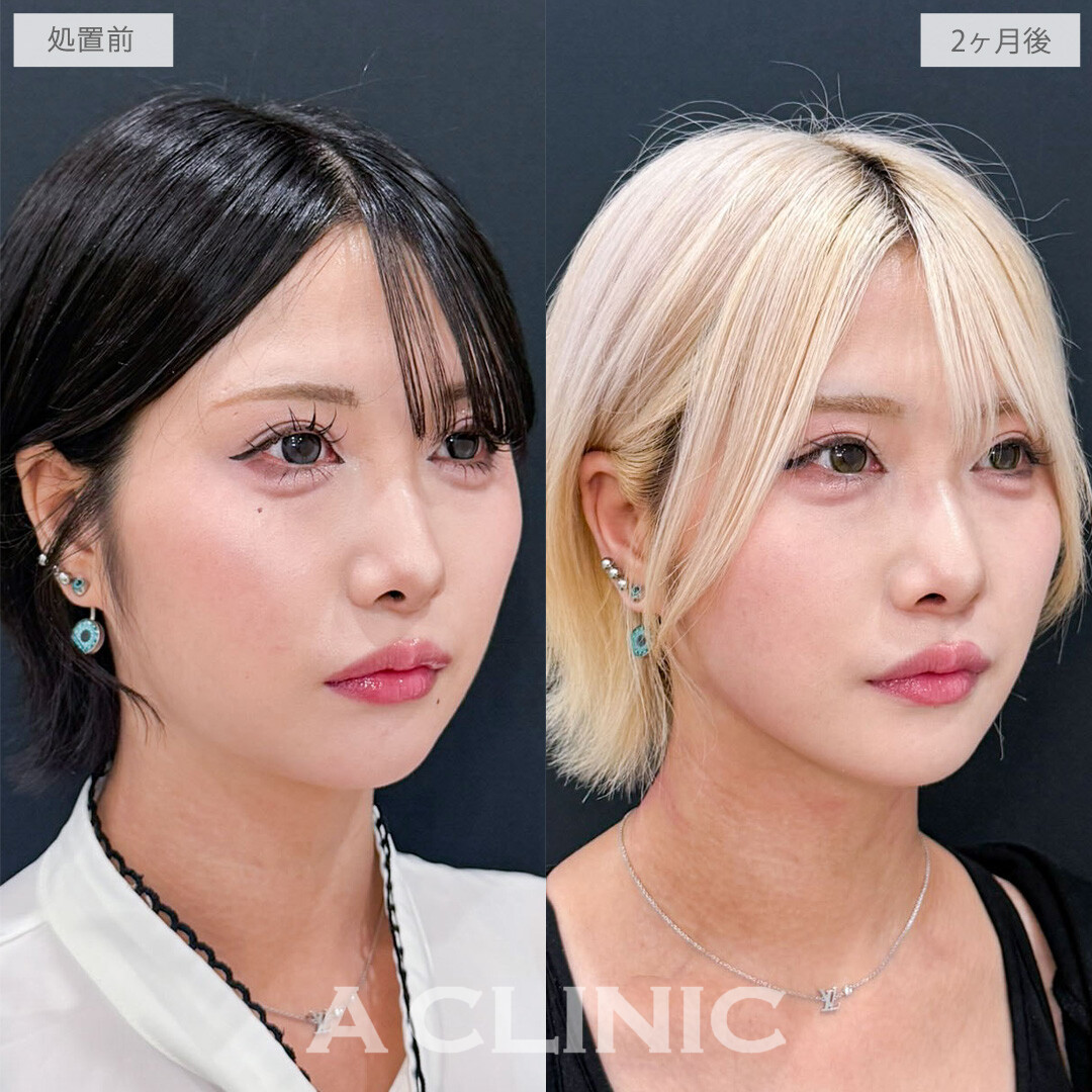 1day小顔脂肪吸引でさらにシャープな印象になりました！こちら処置前と2か月後の症例です(20代女性)