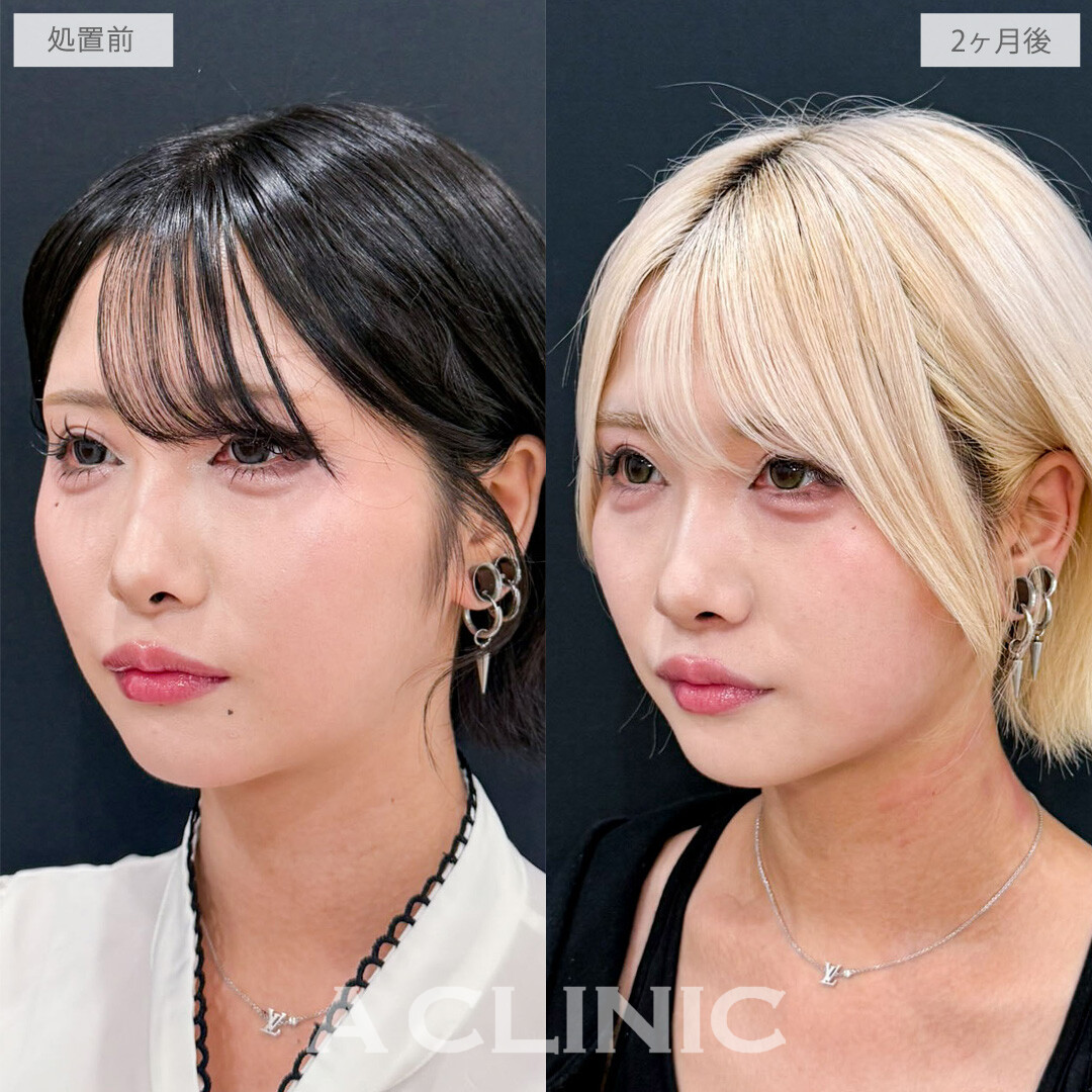 1day小顔脂肪吸引でさらにシャープな印象になりました！こちら処置前と2か月後の症例です(20代女性)