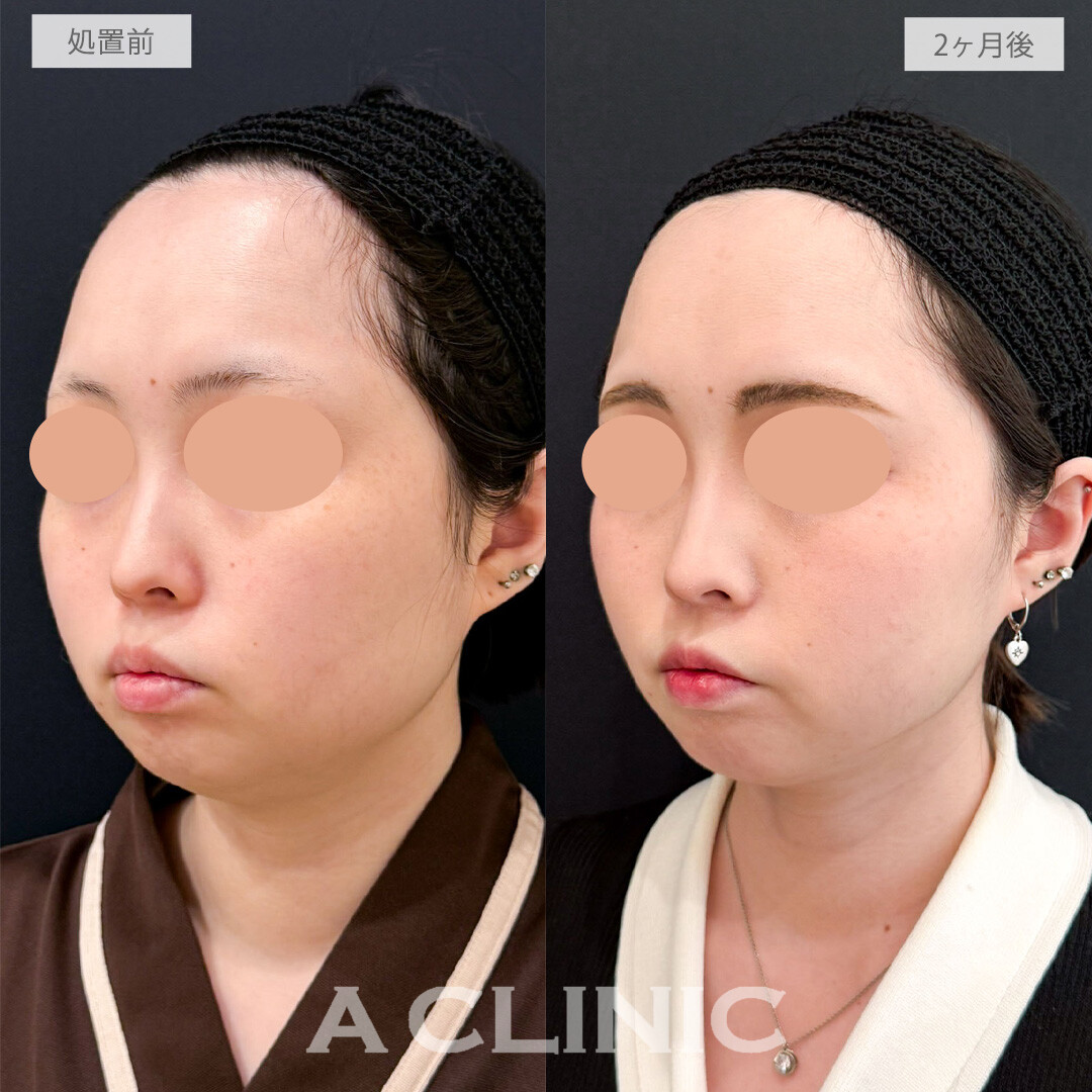 1day小顔脂肪吸引で下顔面がすっきりしてお顔全体の余白が消えました！こちら処置前と2か月後の症例です(20代女性)