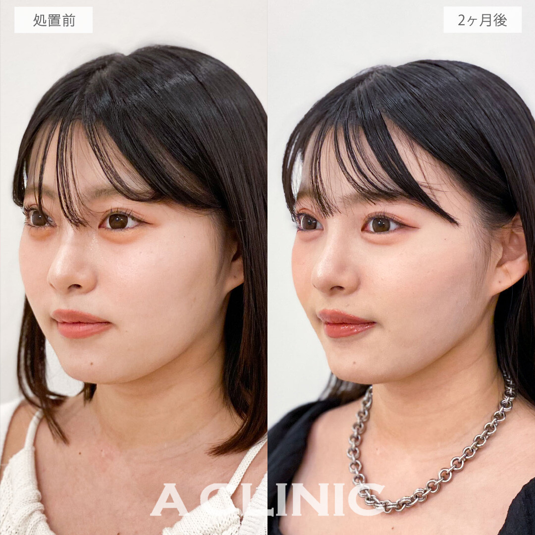 1day小顔脂肪吸引で品格あふれる洗練小顔をデザイン！こちら処置前と2か月後の症例です(20代女性)