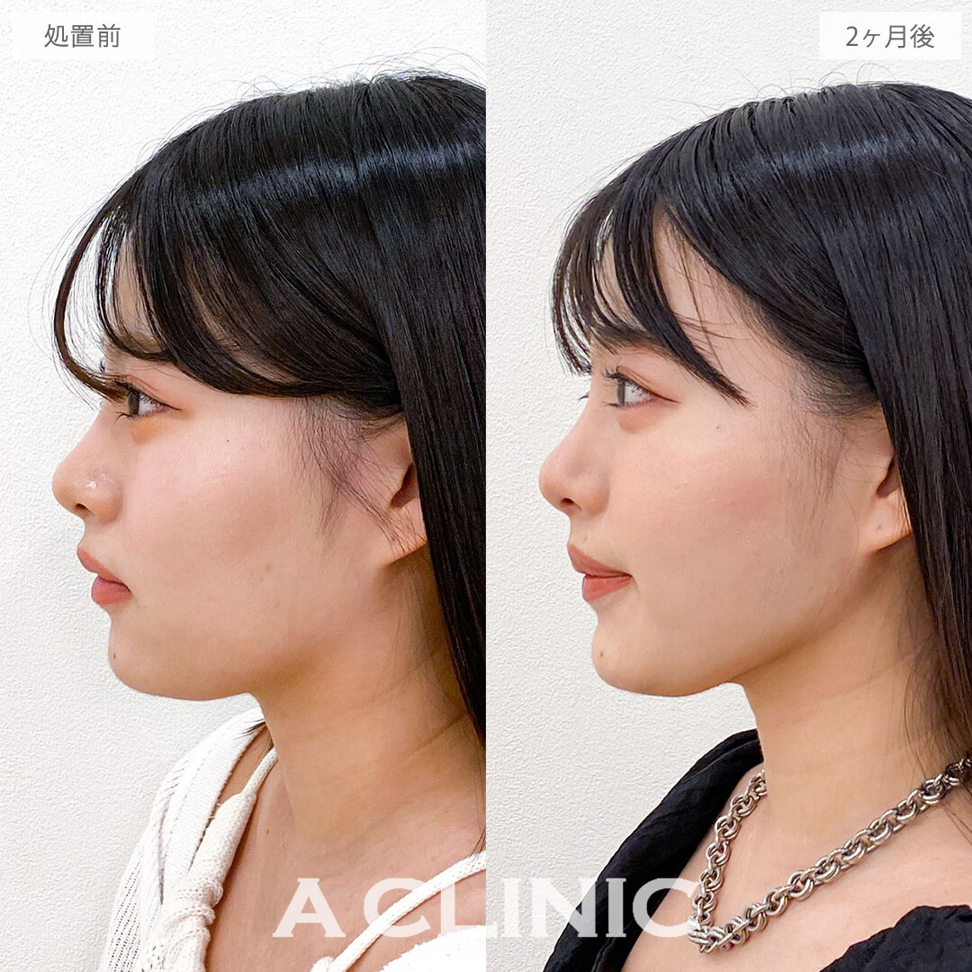 1day小顔脂肪吸引で品格あふれる洗練小顔をデザイン！こちら処置前と2か月後の症例です(20代女性)