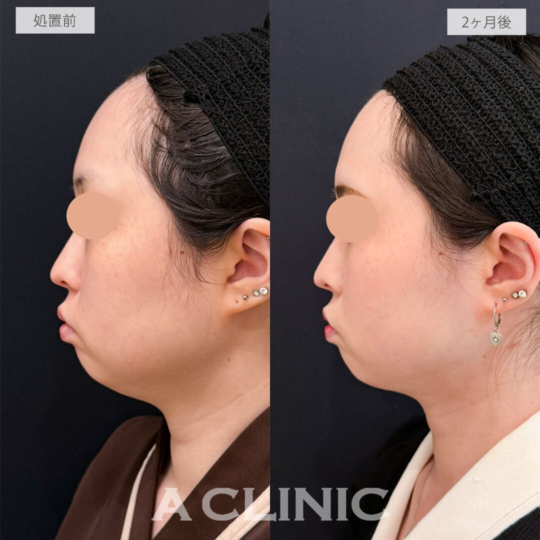 1day小顔脂肪吸引で下顔面がすっきりしてお顔全体の余白が消えました！こちら処置前と2か月後の症例です(20代女性)