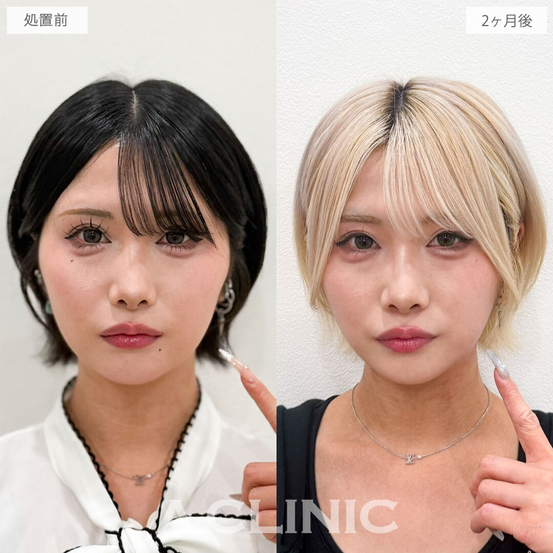 1day小顔脂肪吸引でさらにシャープな印象になりました！こちら処置前と2か月後の症例です(20代女性)