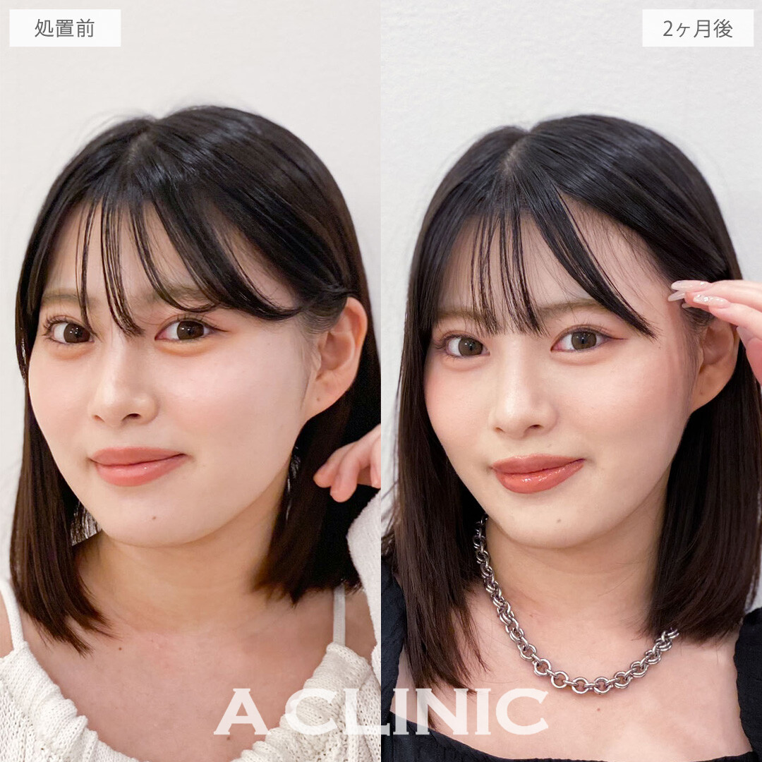 1day小顔脂肪吸引で品格あふれる洗練小顔をデザイン！こちら処置前と2か月後の症例です(20代女性)