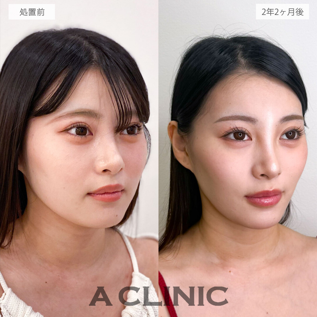 1day小顔脂肪吸引は後戻りなく小顔になれる施術です！こちら処置前と2年2ヶ月後の症例です(20代女性)