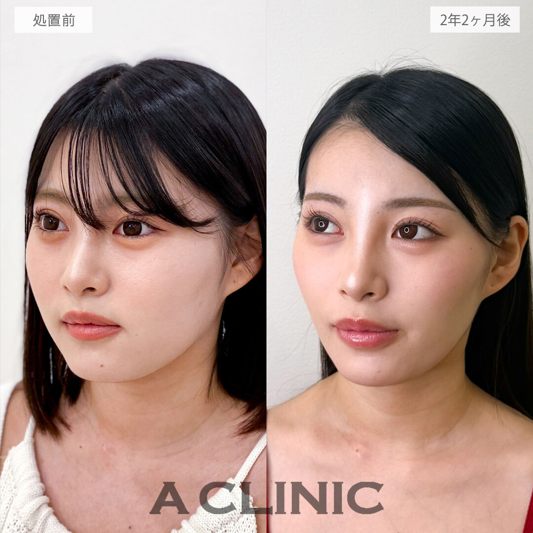 1day小顔脂肪吸引は後戻りなく小顔になれる施術です！こちら処置前と2年2ヶ月後の症例です(20代女性)