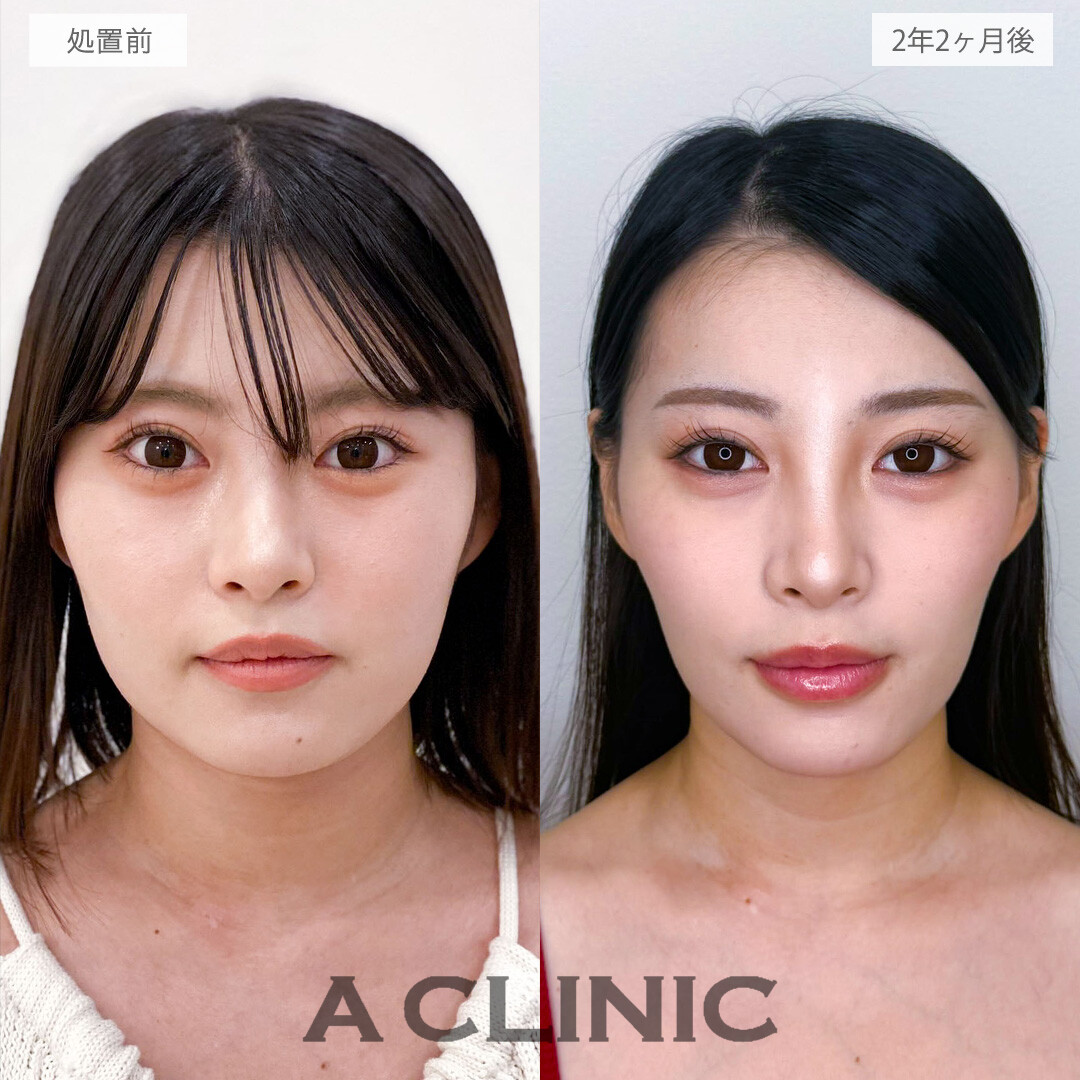 1day小顔脂肪吸引は後戻りなく小顔になれる施術です！こちら処置前と2年2ヶ月後の症例です(20代女性)