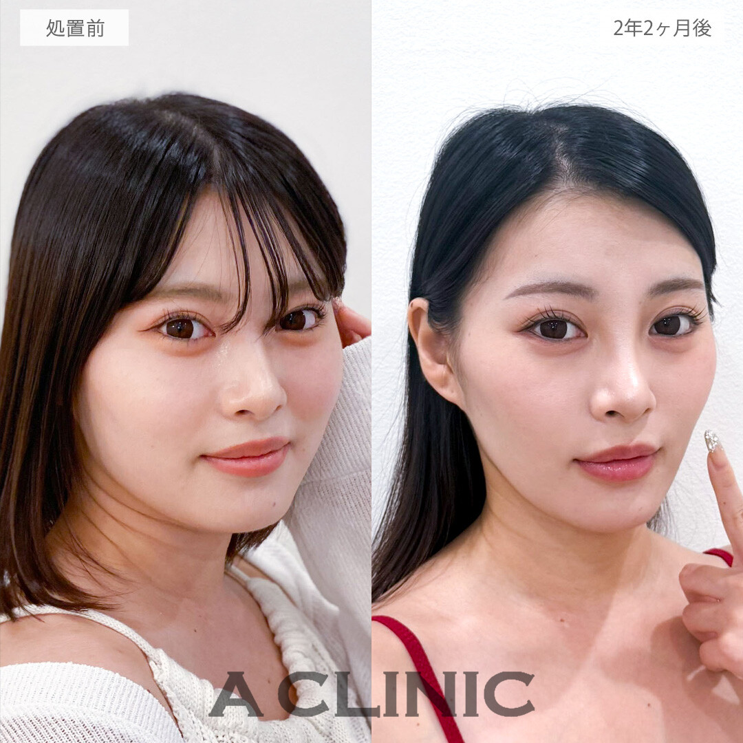 1day小顔脂肪吸引は後戻りなく小顔になれる施術です！こちら処置前と2年2ヶ月後の症例です(20代女性)