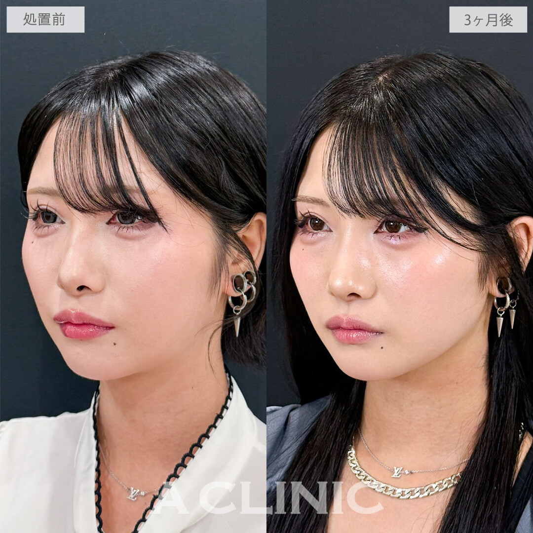1day小顔脂肪吸引でコケずに自然に垢抜けます！こちら処置前と3か月後の症例です(20代女性)