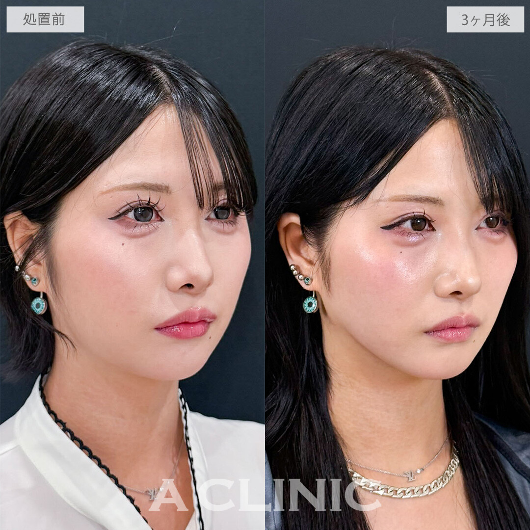 1day小顔脂肪吸引でコケずに自然に垢抜けます！こちら処置前と3か月後の症例です(20代女性)