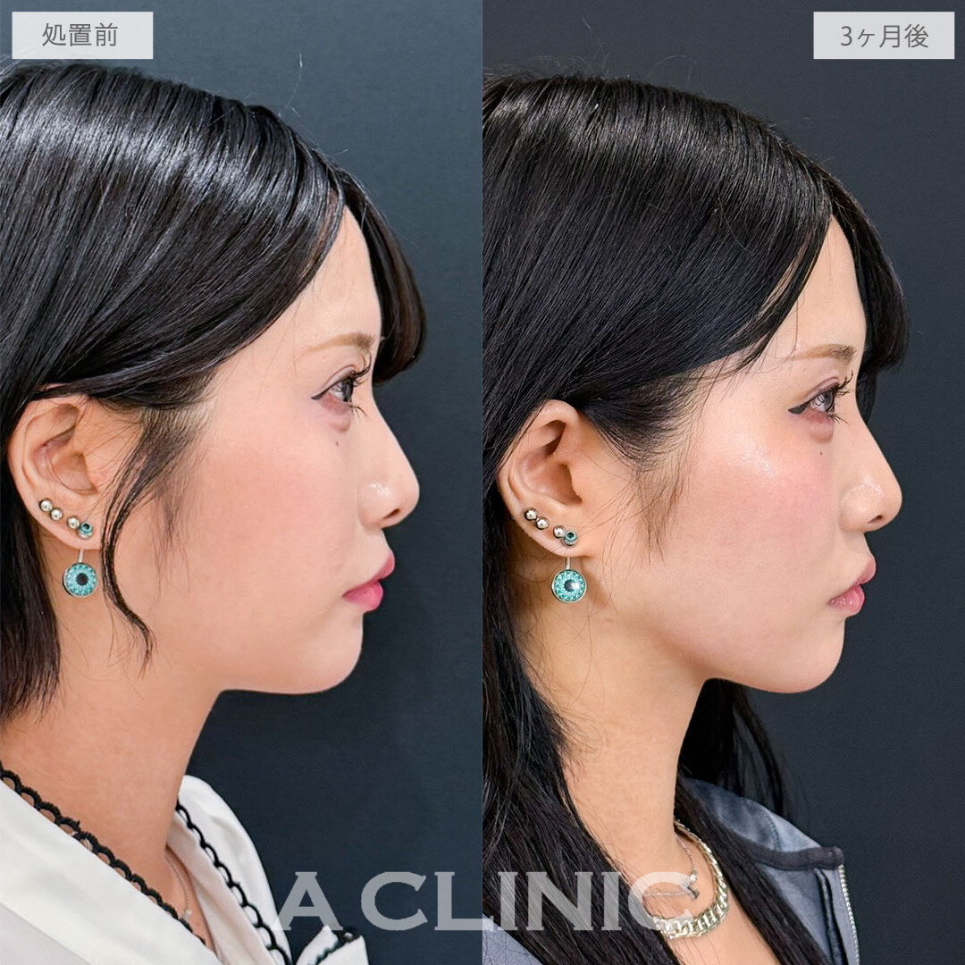 1day小顔脂肪吸引でコケずに自然に垢抜けます！こちら処置前と3か月後の症例です(20代女性)