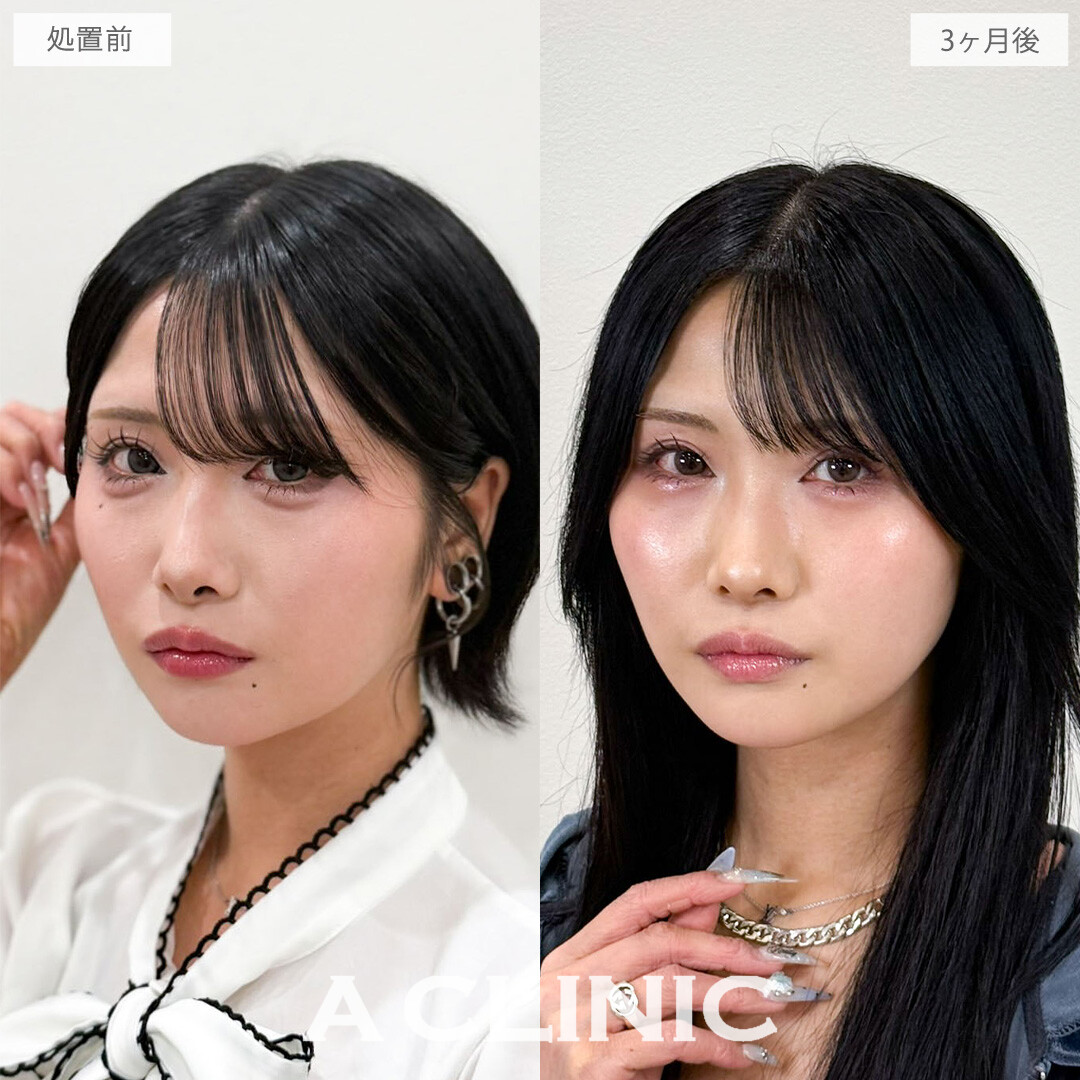 1day小顔脂肪吸引でコケずに自然に垢抜けます！こちら処置前と3か月後の症例です(20代女性)