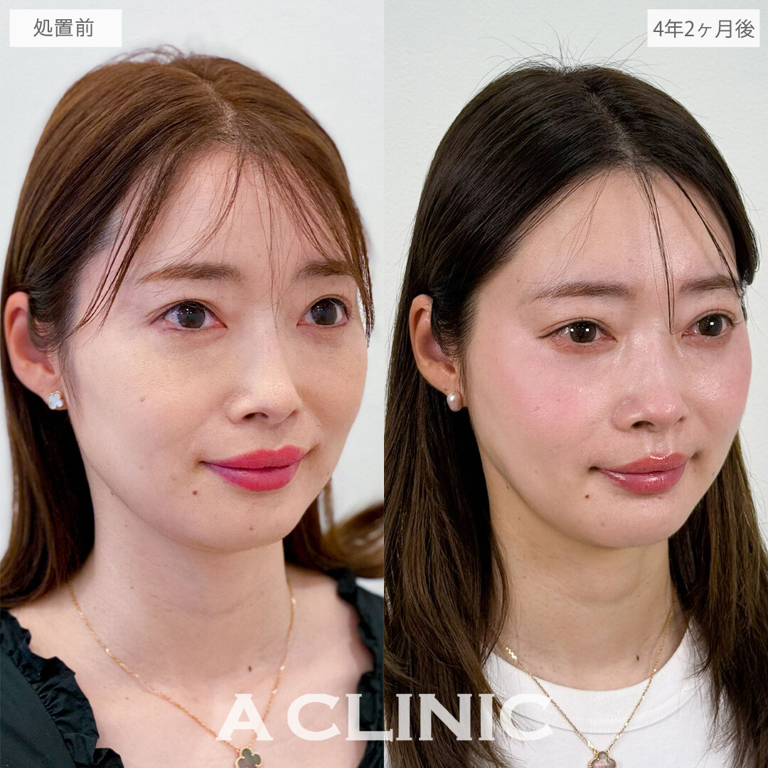 1day小顔脂肪吸引で4年後の今も若々しくリバウンド知らずの小顔に！こちら処置前と4年2か月後の症例です(30代女性)