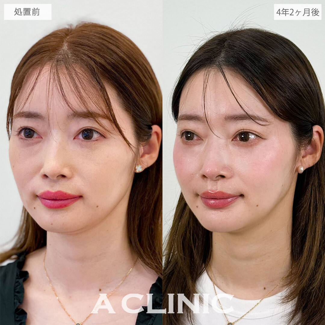 1day小顔脂肪吸引で4年後の今も若々しくリバウンド知らずの小顔に！こちら処置前と4年2か月後の症例です(30代女性)