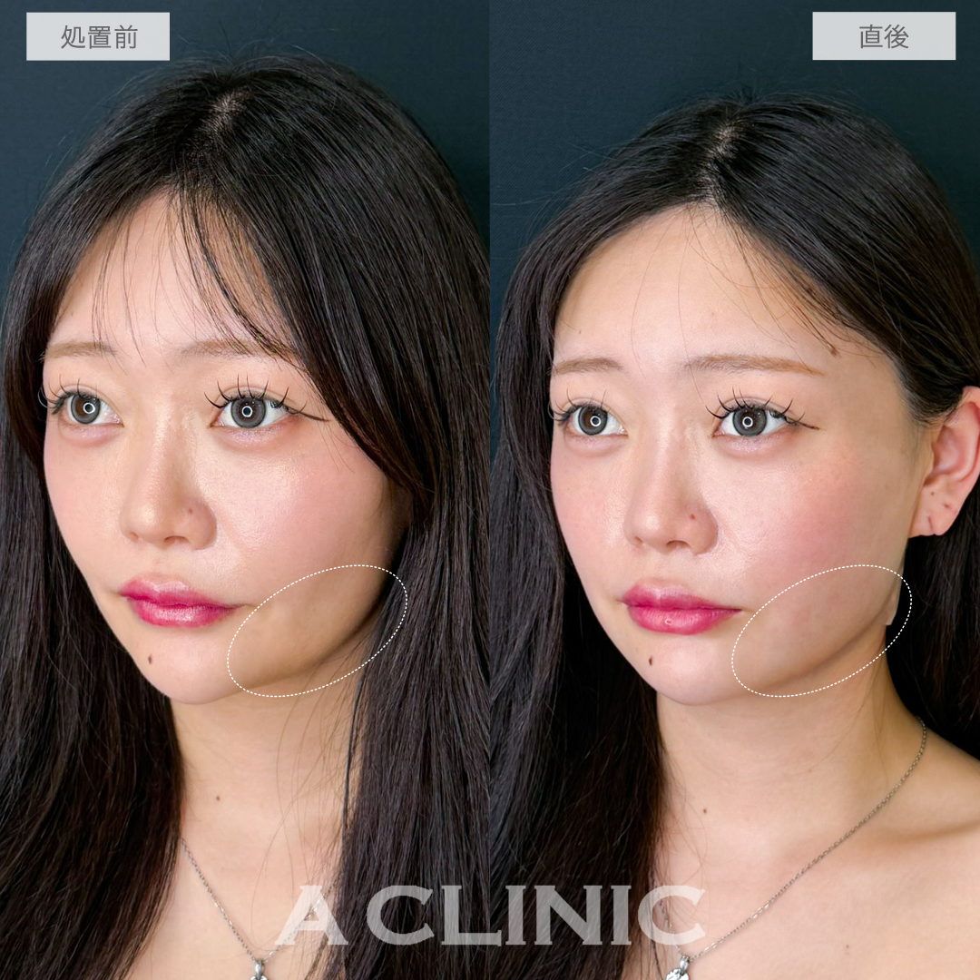 1day小顔脂肪吸引は直後でも自然な小顔効果を実感できます！こちら処置前と直後の症例です(20代女性)