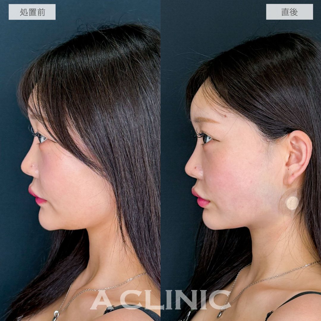 1day小顔脂肪吸引は直後でも自然な小顔効果を実感できます！こちら処置前と直後の症例です(20代女性)