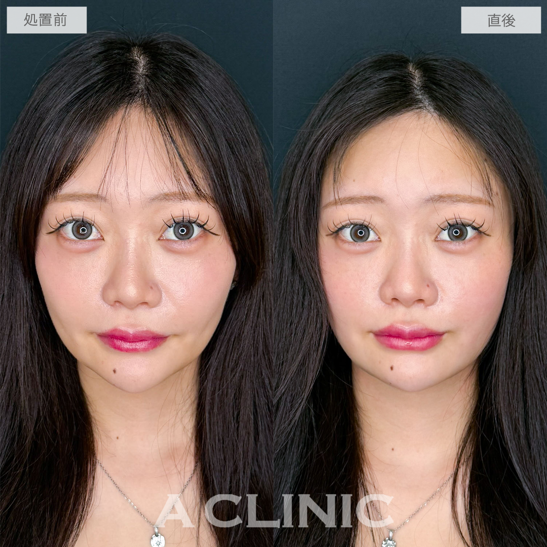 1day小顔脂肪吸引は直後でも自然な小顔効果を実感できます！こちら処置前と直後の症例です(20代女性)