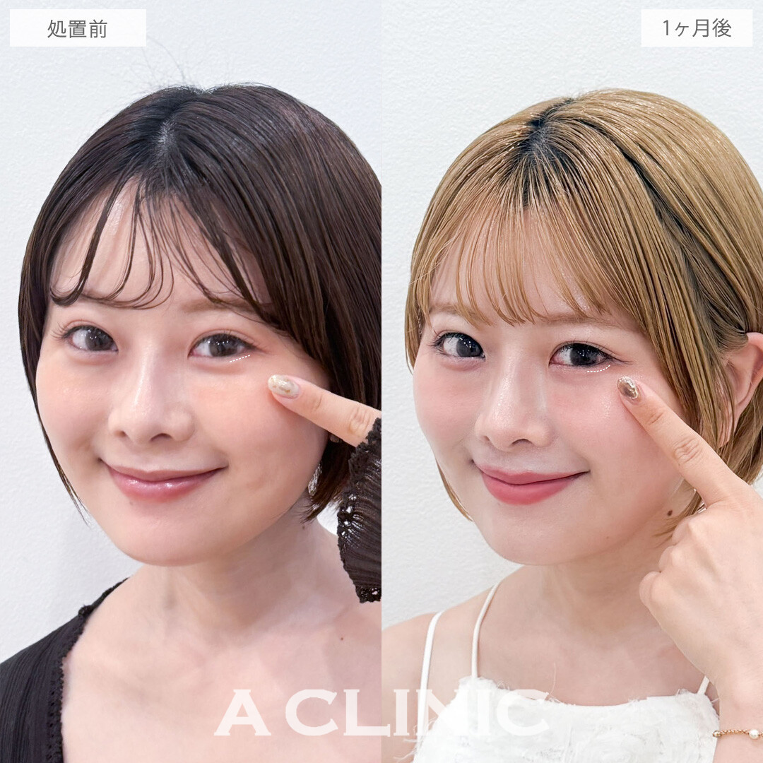 パーフェクトアイズで親しみやすく愛される目元をプロデュース！こちら処置前と1か月後の症例です(20代女性)