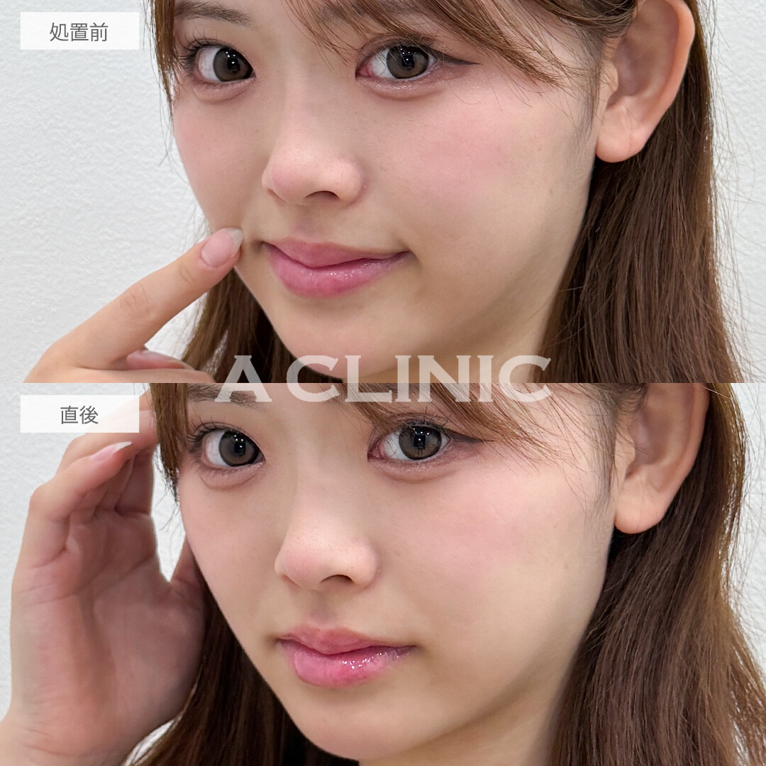 人中が短く見えることで中顔面短縮効果もございます！スマイルリップの処置前と直後の症例です(20代女性)