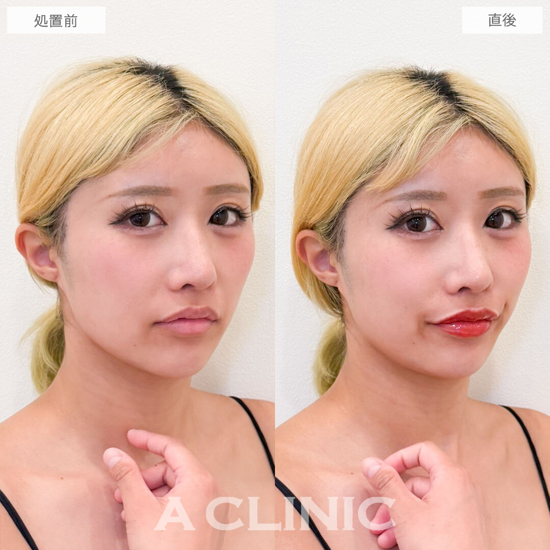 スマイルリップで上向き口角を作ってキュートで好印象な口元に！こちら処置前と直後の症例です(20代女性)