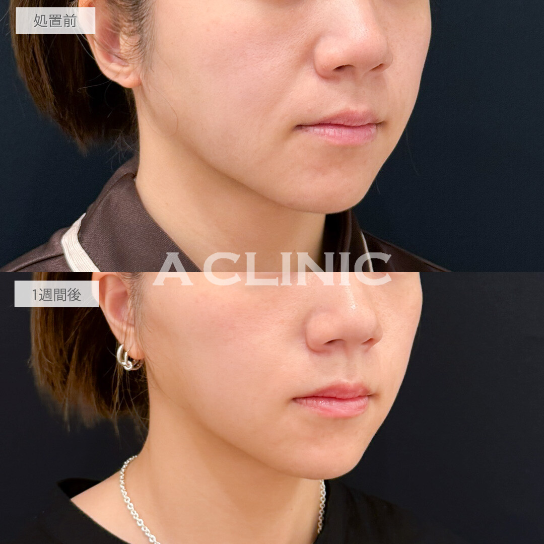 A式たるみ切開で老け見えするほうれい線を撃退！処置前と1週間後の症例です(30代女性)