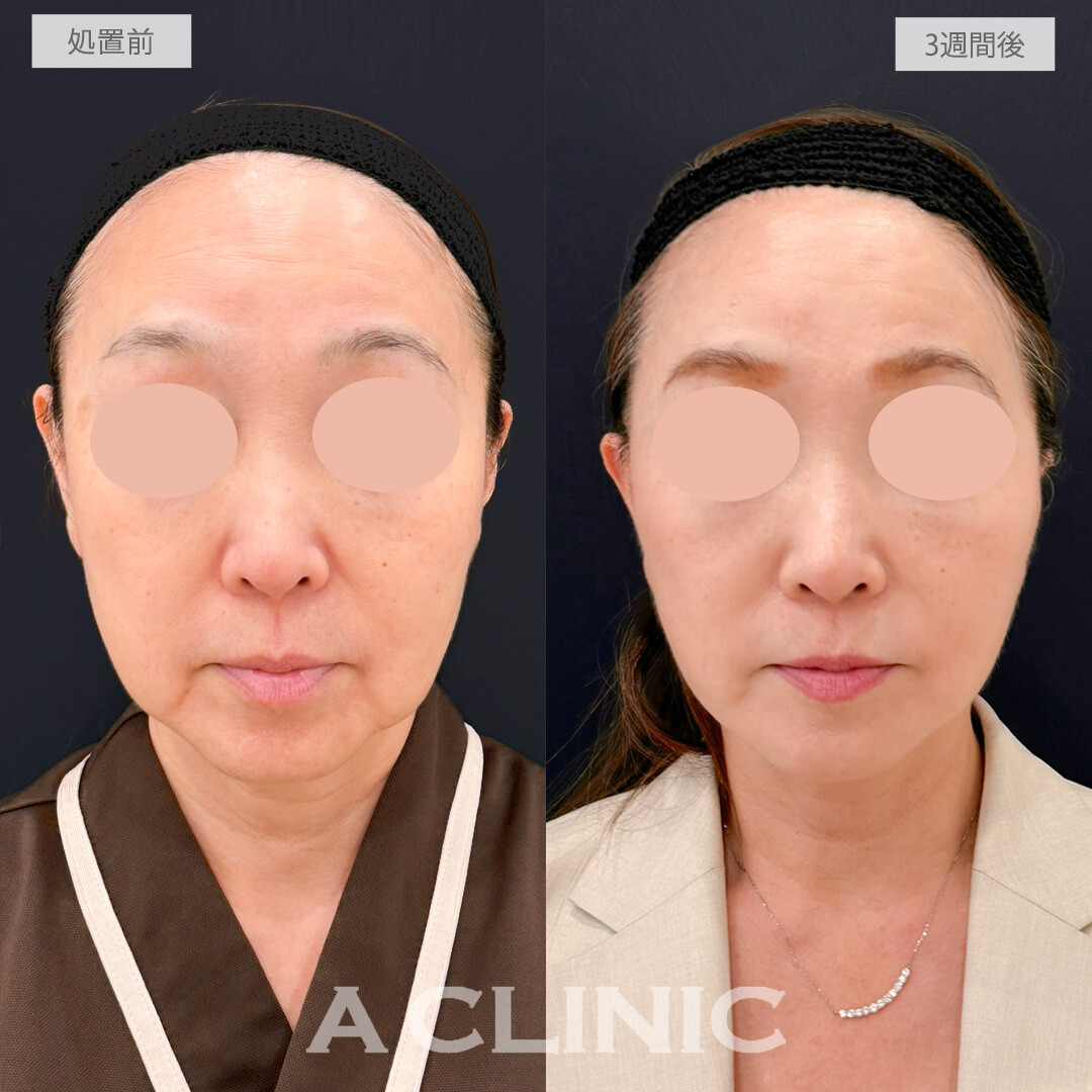 A式たるみ切開と1day小顔脂肪吸引は手っ取り早く若返りを実感したい方にオススメ！処置前と3週間後の症例です(60代女性)