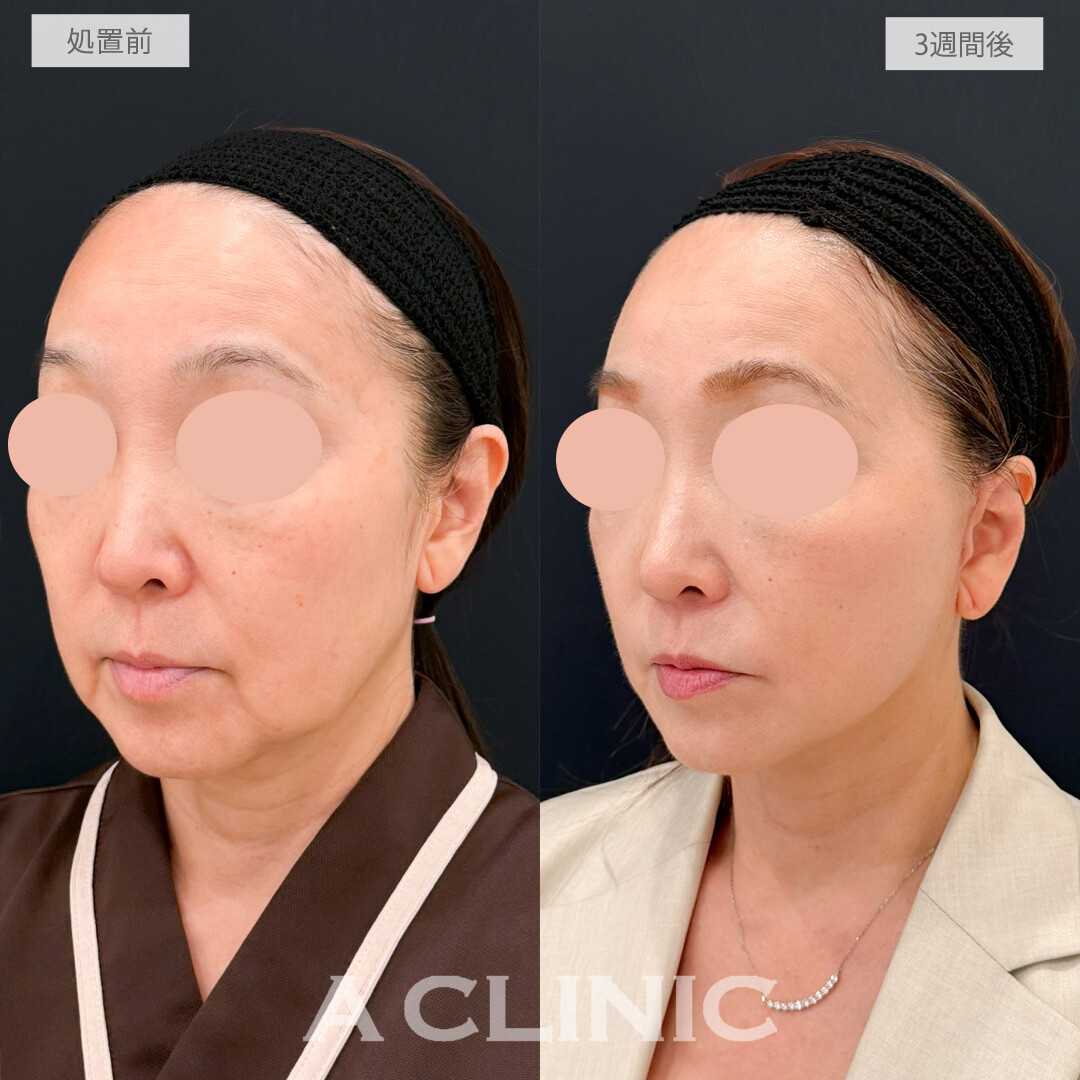 A式たるみ切開と1day小顔脂肪吸引は手っ取り早く若返りを実感したい方にオススメ！処置前と3週間後の症例です(60代女性)