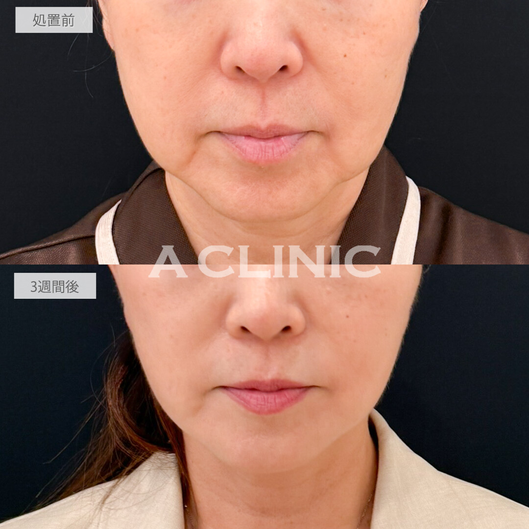 A式たるみ切開と1day小顔脂肪吸引は手っ取り早く若返りを実感したい方にオススメ！処置前と3週間後の症例です(60代女性)