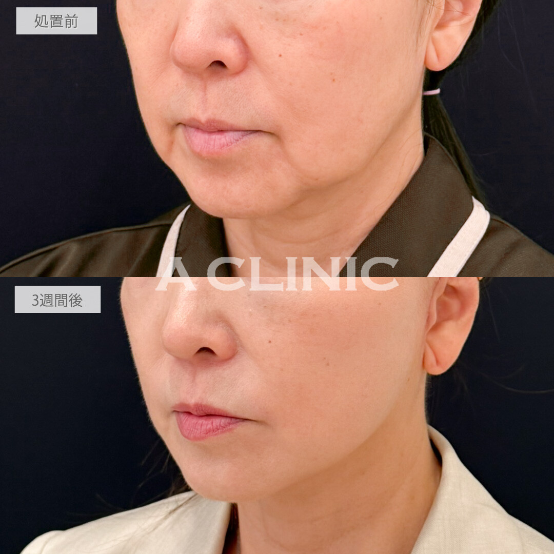 A式たるみ切開と1day小顔脂肪吸引は手っ取り早く若返りを実感したい方にオススメ！処置前と3週間後の症例です(60代女性)