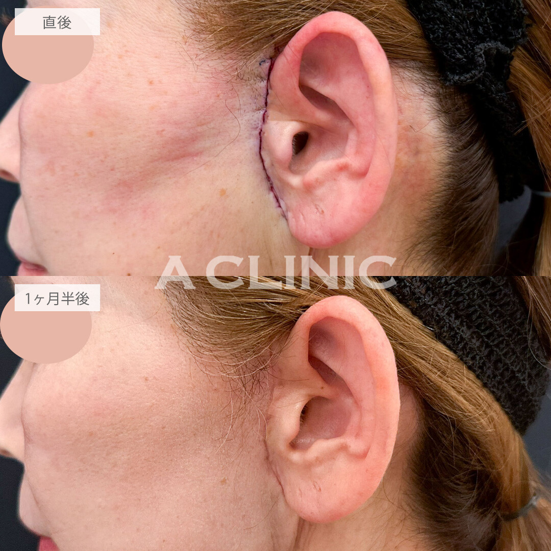 【直後の傷跡あり】A式たるみ切開で口横のたるみを整え若々しいフェイスラインに！こちら処置前と1ヶ月半後の症例です(50代女性)