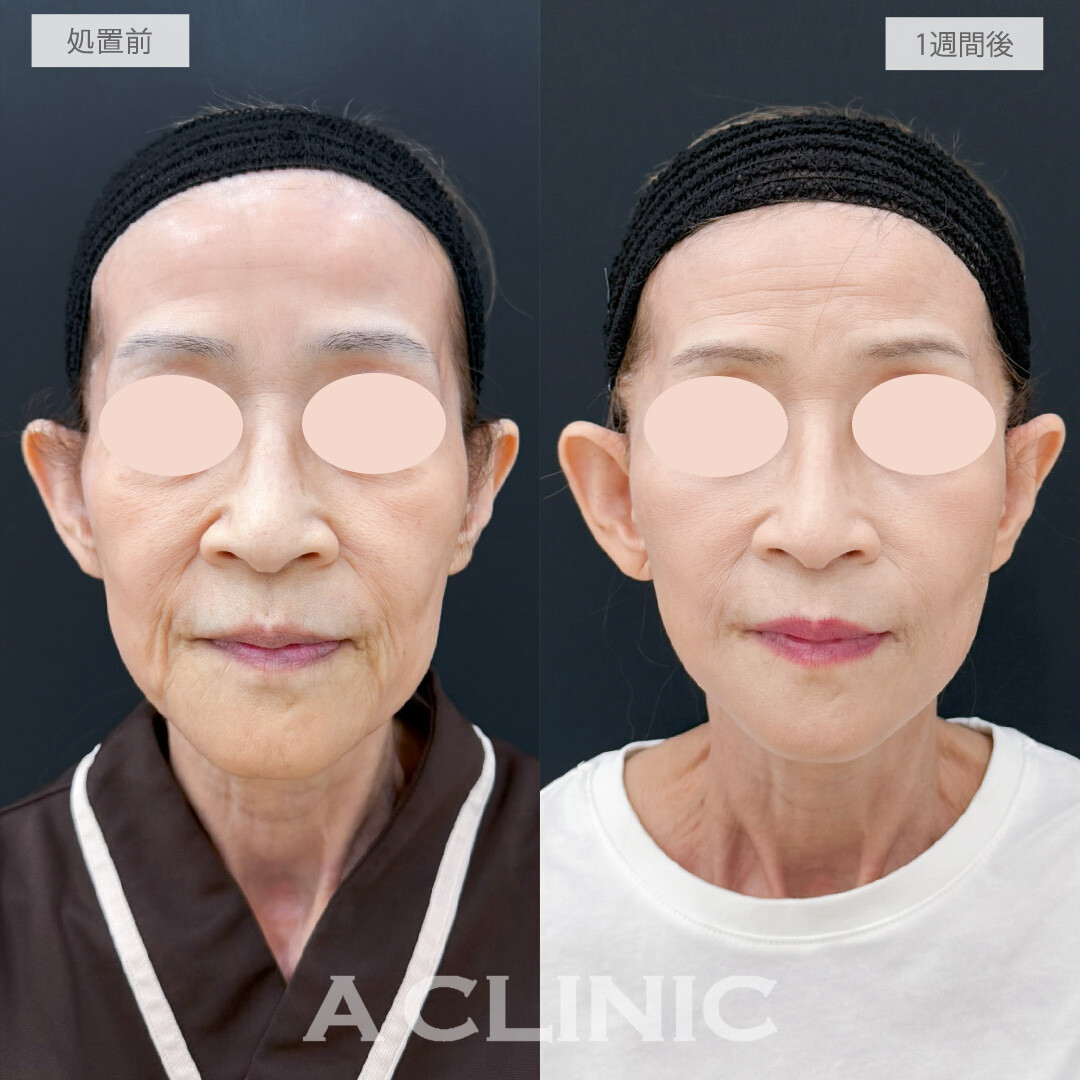 A式たるみ切開でスキンケアだけでは叶えられないほどのしわ改善を実感！処置前と1週間後の症例です(50代女性)