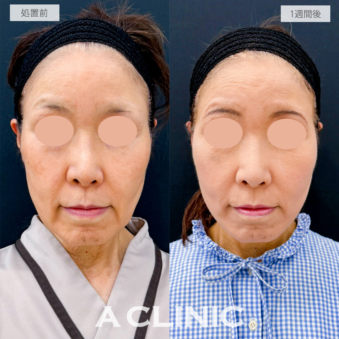 A式たるみ切開で時を重ねてもいつまでも若々しい上質なフェイスラインへ！こちら処置前と1週間後の症例です(60代女性)