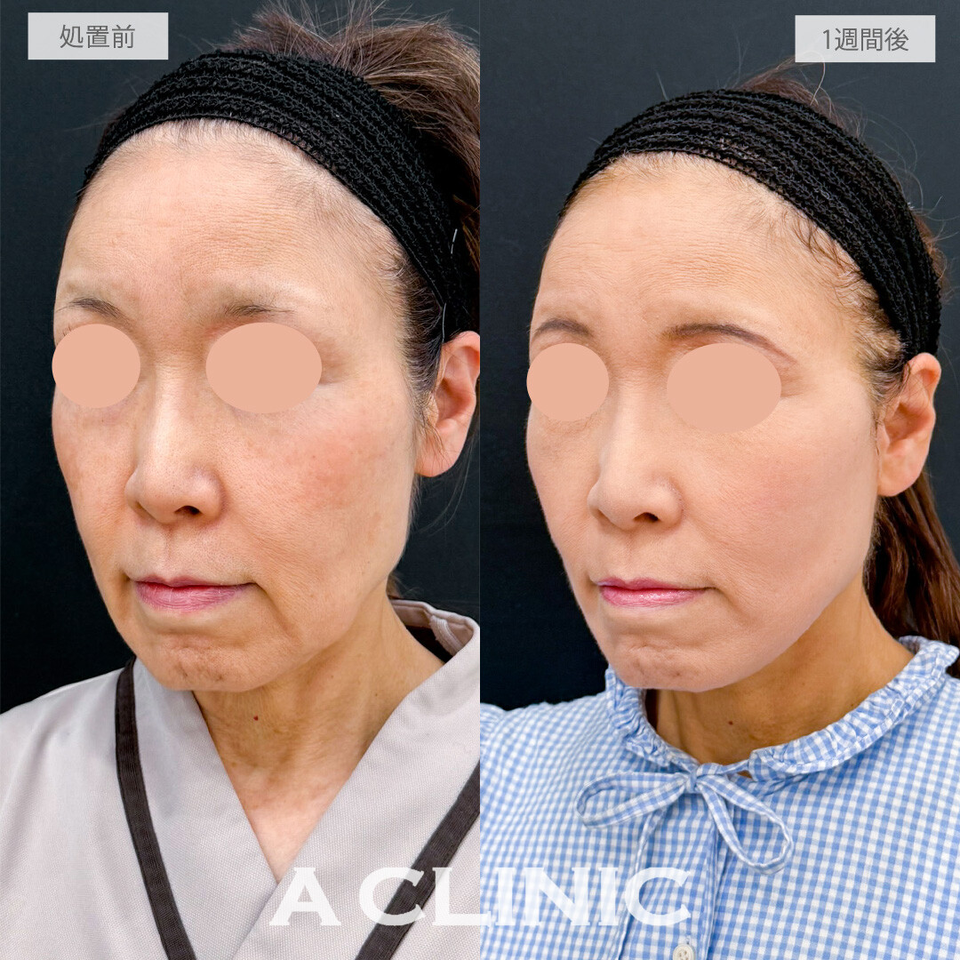 A式たるみ切開で時を重ねてもいつまでも若々しい上質なフェイスラインへ！こちら処置前と1週間後の症例です(60代女性)