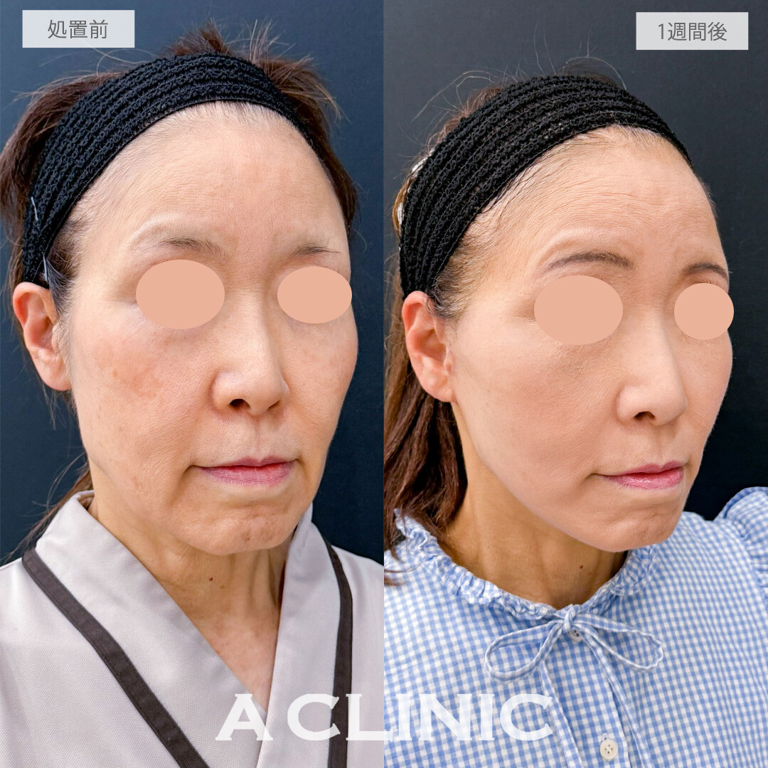 A式たるみ切開で時を重ねてもいつまでも若々しい上質なフェイスラインへ！こちら処置前と1週間後の症例です(60代女性)