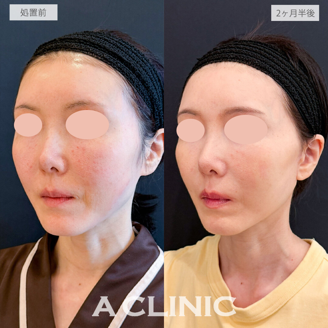 【直後の傷跡あり】A式たるみ切開でお疲れ顔を自然にリセット！こちら処置前から2ヶ月半後の症例です(50代女性)