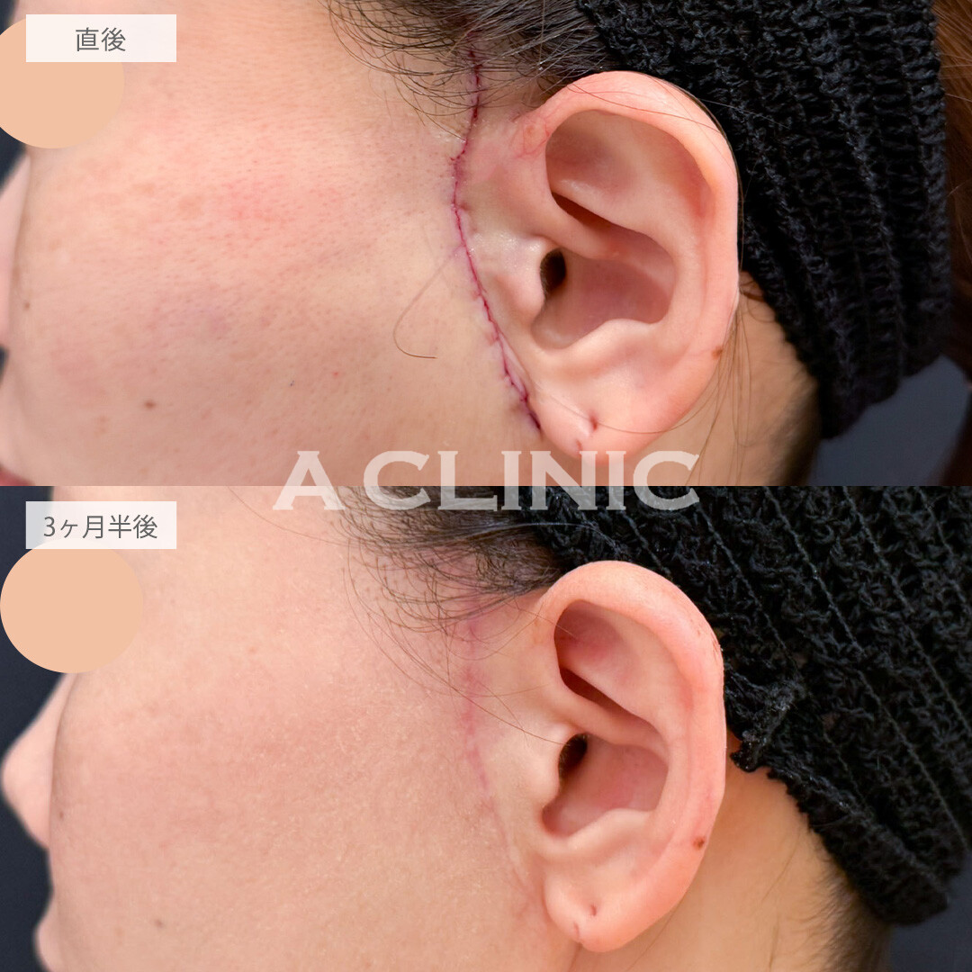 【直後の傷跡あり】A式たるみ切開で大人のたるみを美しくリセット！こちら処置前と3ヶ月半後の症例です(40代女性)