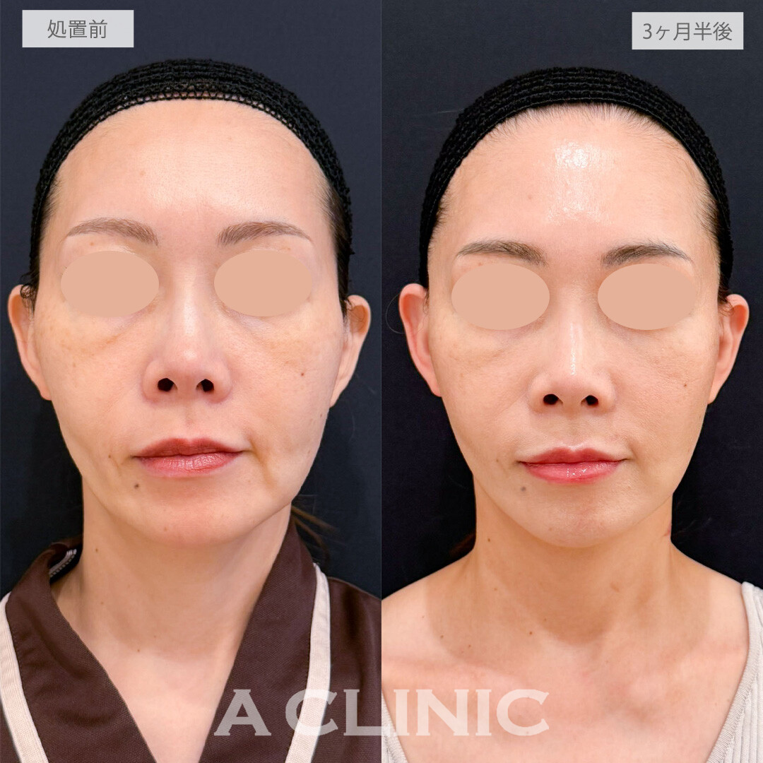【直後の傷跡あり】A式たるみ切開で大人のたるみを美しくリセット！こちら処置前と3ヶ月半後の症例です(40代女性)