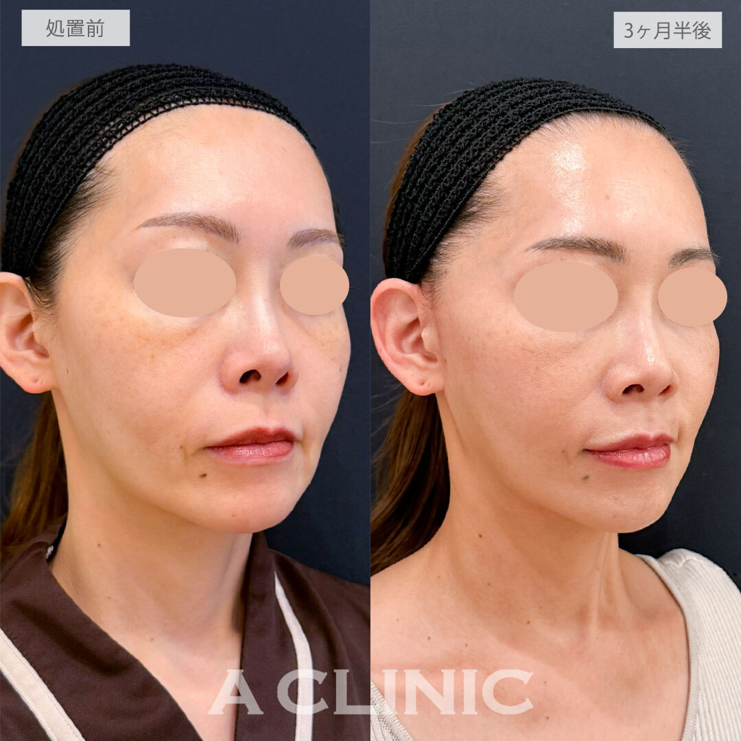 【直後の傷跡あり】A式たるみ切開で大人のたるみを美しくリセット！こちら処置前と3ヶ月半後の症例です(40代女性)