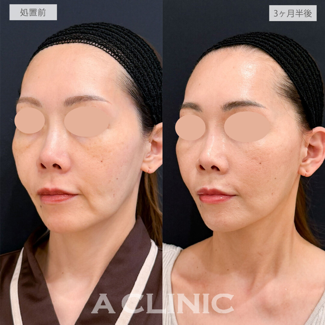 【直後の傷跡あり】A式たるみ切開で大人のたるみを美しくリセット！こちら処置前と3ヶ月半後の症例です(40代女性)