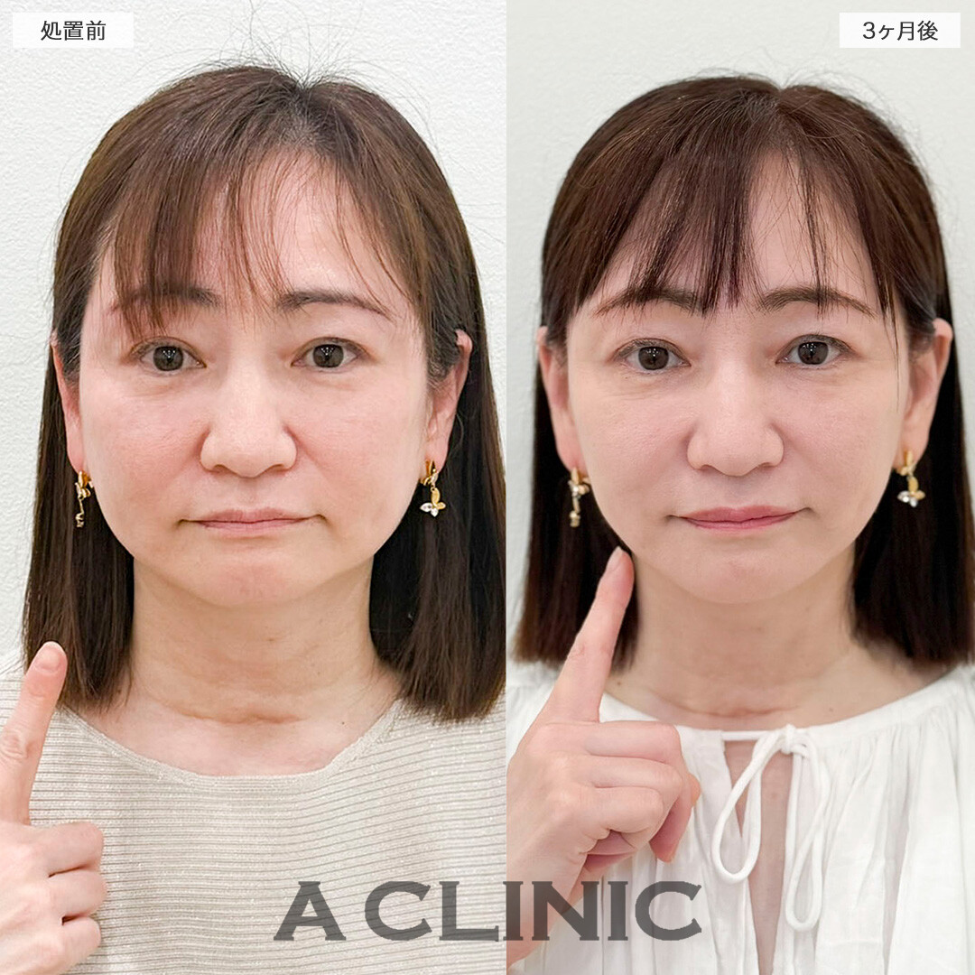 1day小顔脂肪吸引とA式たるみ切開で若々しい印象を取り戻しました！処置前と3ヶ月後の症例です(50代女性)