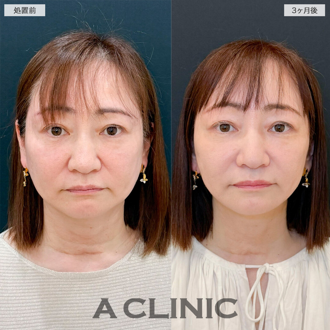 1day小顔脂肪吸引とA式たるみ切開で若々しい印象を取り戻しました！処置前と3ヶ月後の症例です(50代女性)