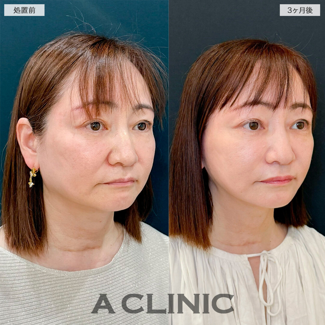 1day小顔脂肪吸引とA式たるみ切開で若々しい印象を取り戻しました！処置前と3ヶ月後の症例です(50代女性)