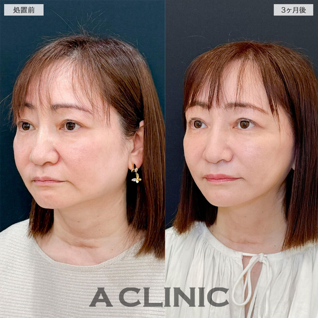 1day小顔脂肪吸引とA式たるみ切開で若々しい印象を取り戻しました！処置前と3ヶ月後の症例です(50代女性)