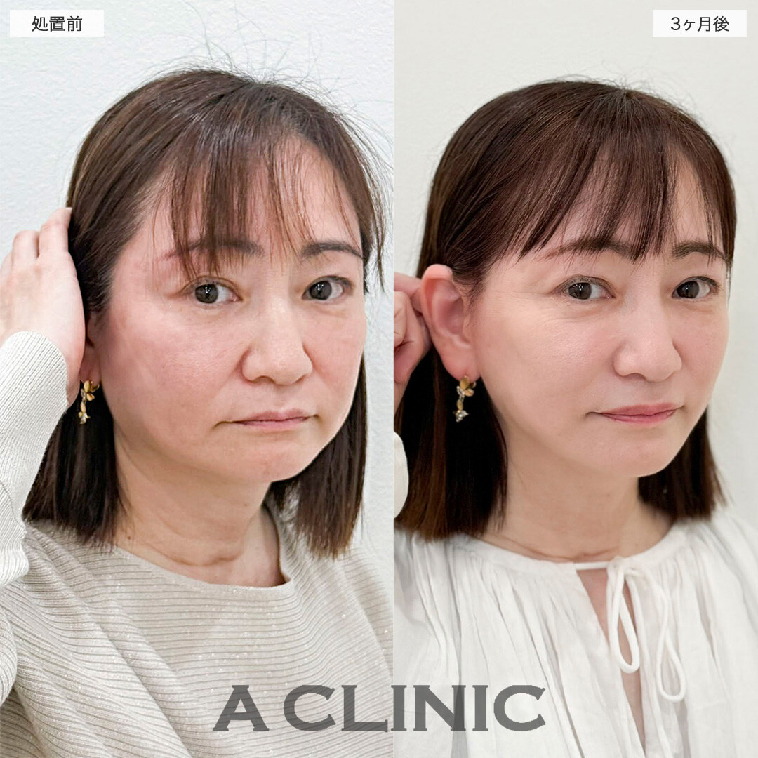 1day小顔脂肪吸引とA式たるみ切開で若々しい印象を取り戻しました！処置前と3ヶ月後の症例です(50代女性)