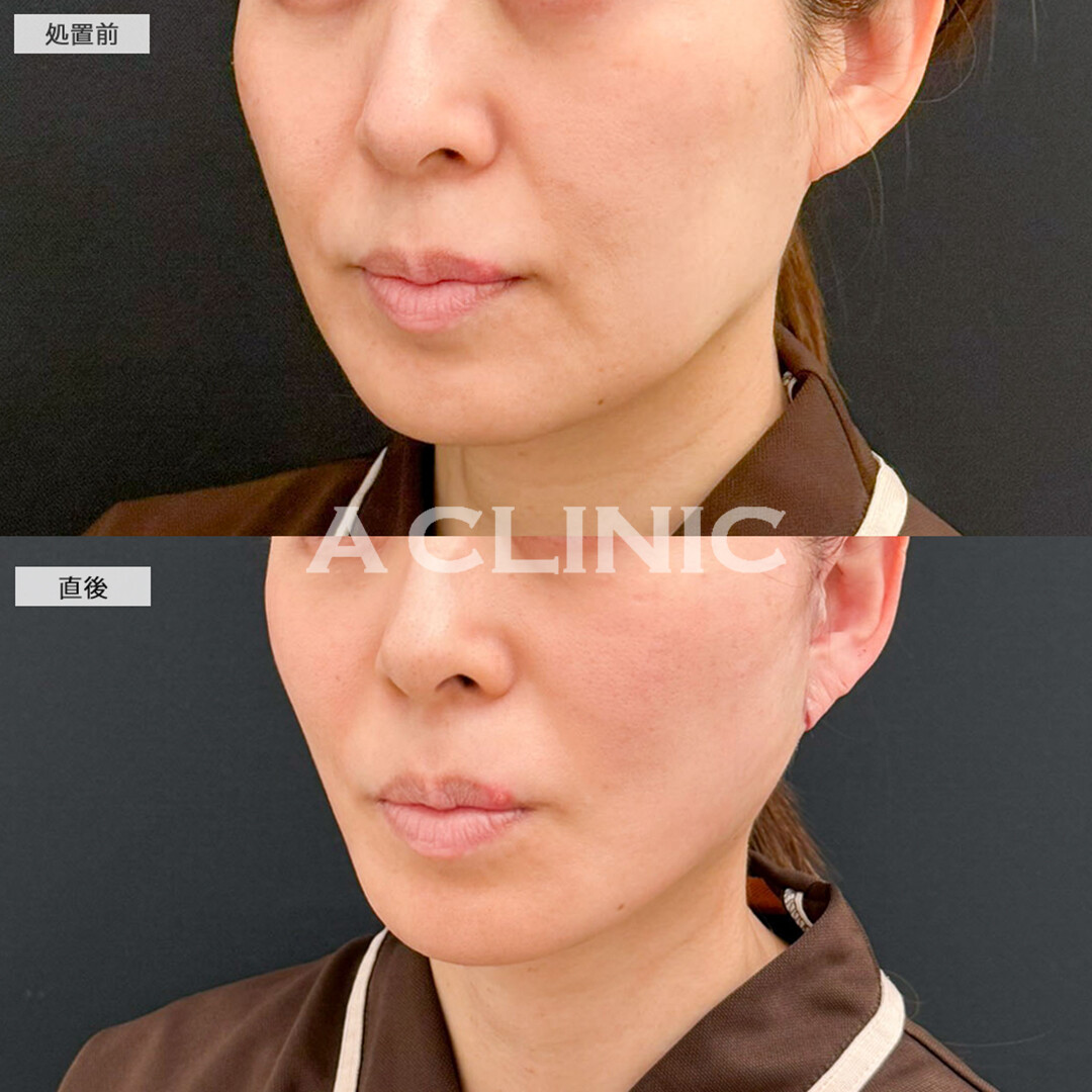 A式たるみ切開で直後からしっかり引きあがり若返り成功！こちら処置前と直後の症例です(40代女性)