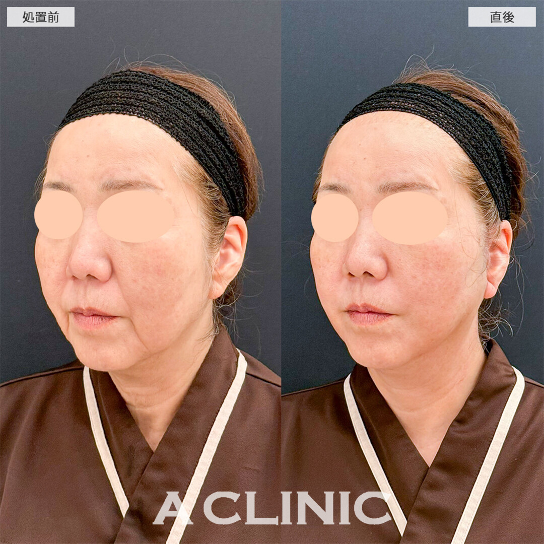 A式たるみ切開は直後から若返りが可能です！こちら処置前と直後の症例です(60代女性)