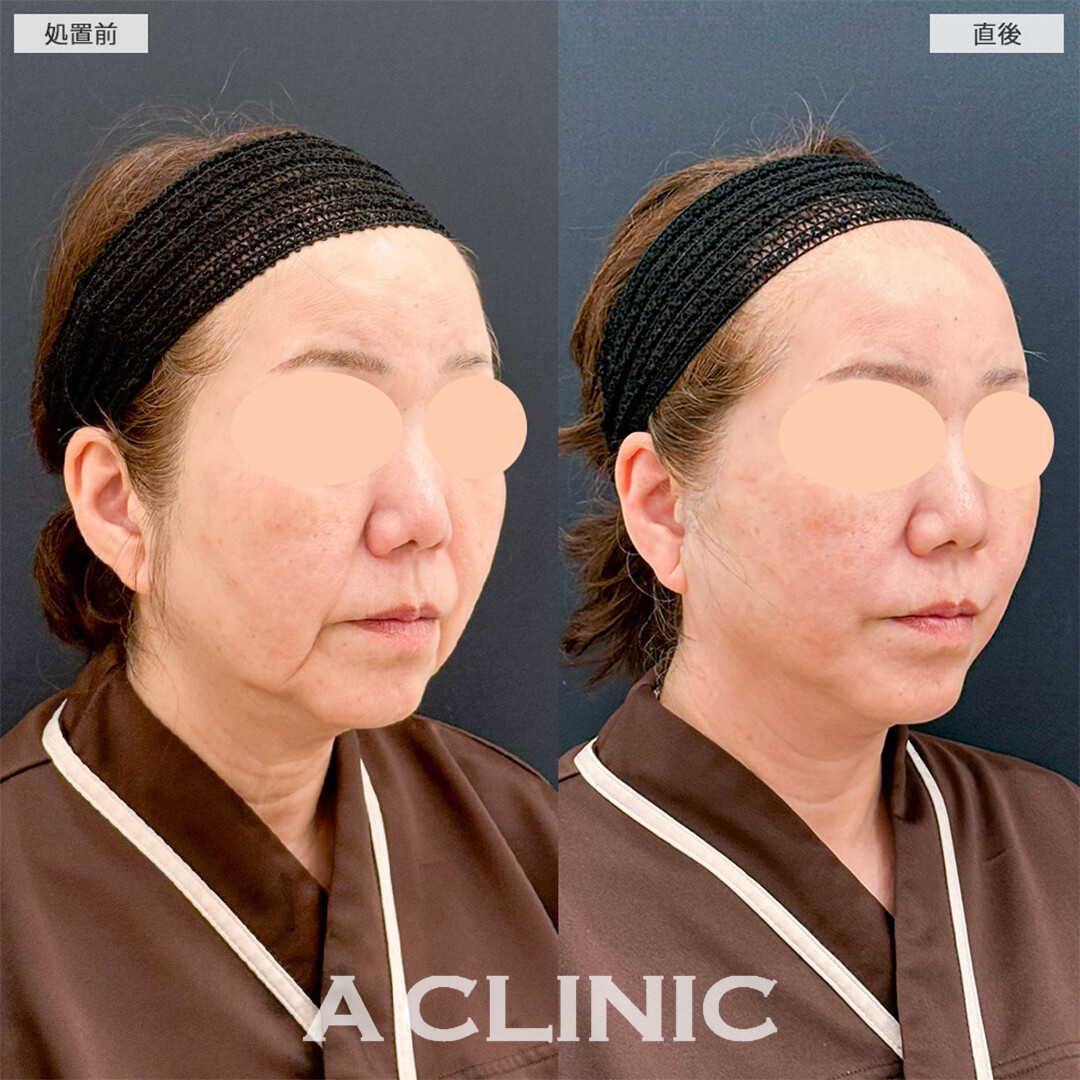 A式たるみ切開は直後から若返りが可能です！こちら処置前と直後の症例です(60代女性)