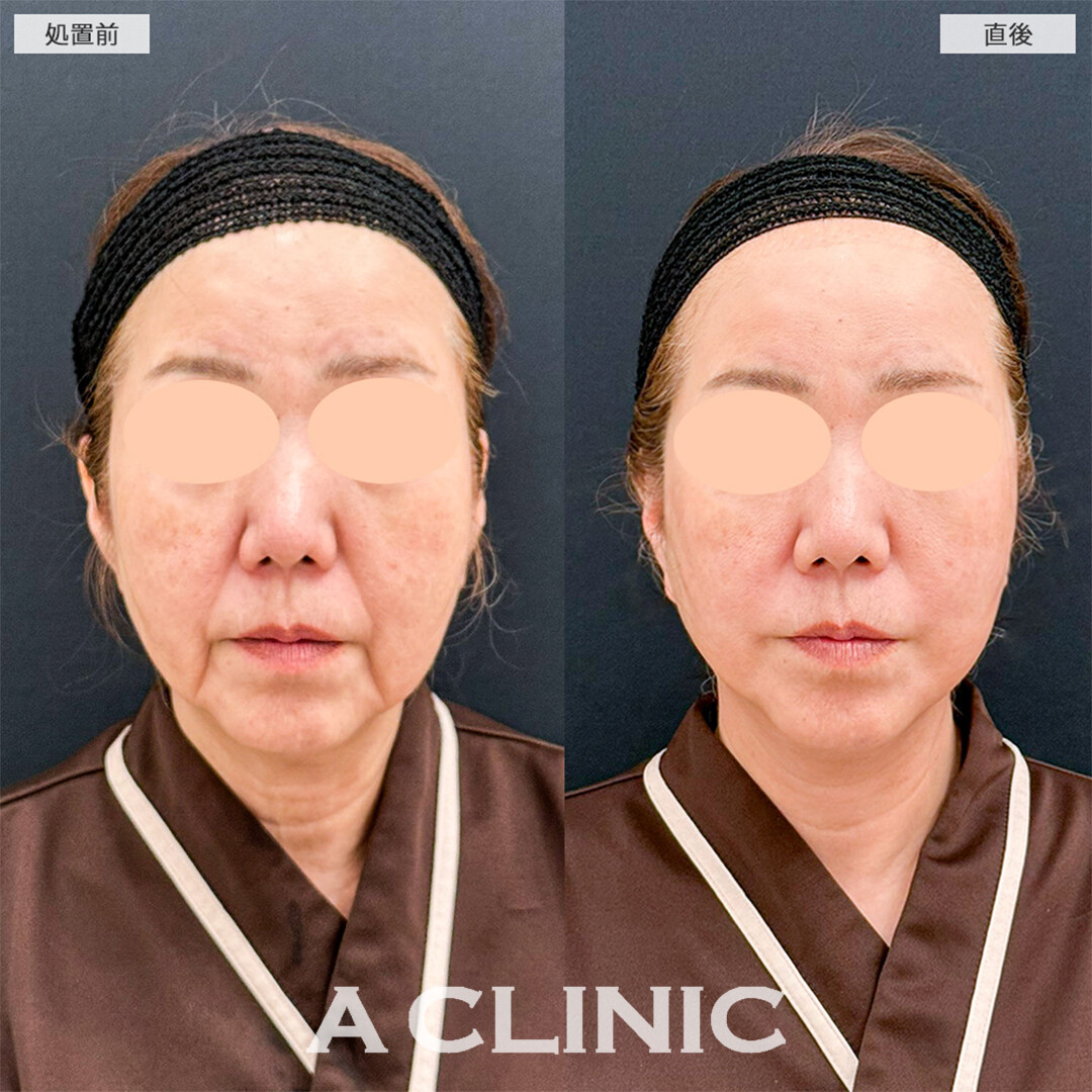 A式たるみ切開は直後から若返りが可能です！こちら処置前と直後の症例です(60代女性)